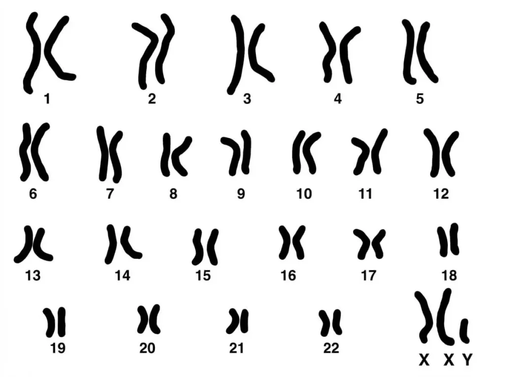 Caryotype d'un homme atteint du syndrome de Klinefelter montrant une formule chromosomique 47, XXY.