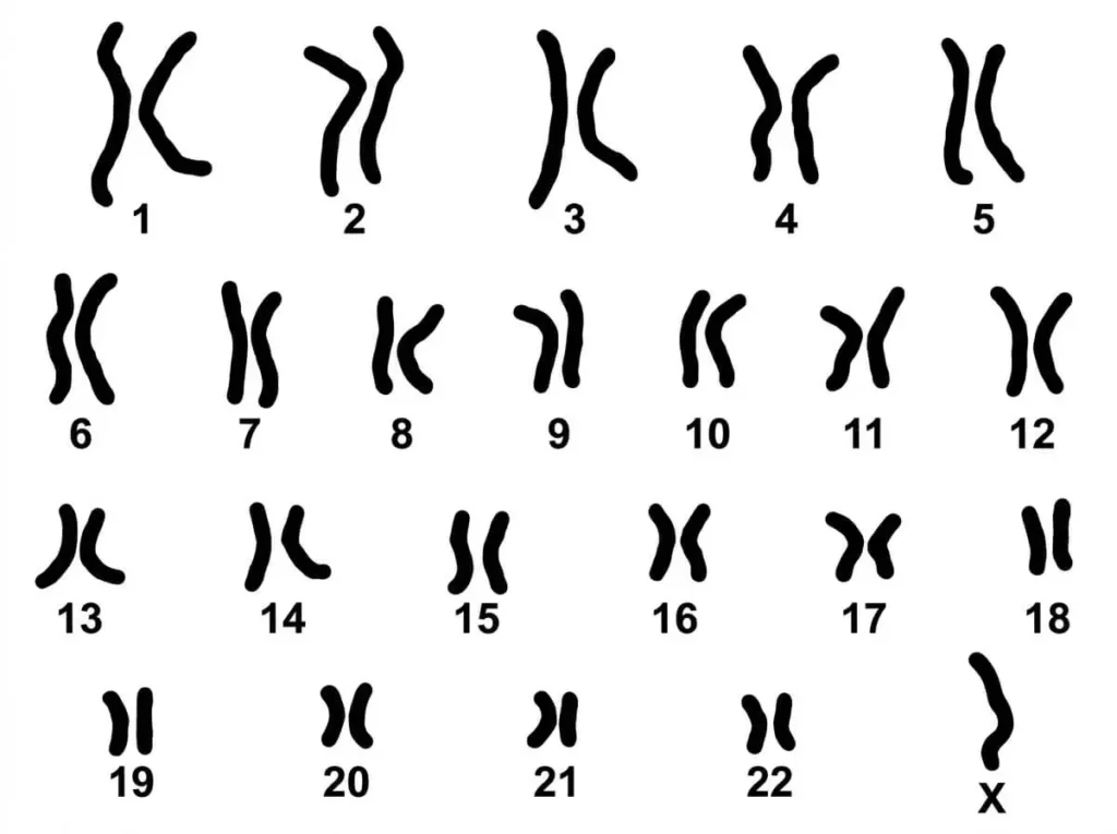 Caryotype d'une femme atteinte du syndrome de Turner montrant l'absence d'un chromosome X (formule 45, X0).